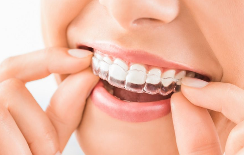 Smile Confidently: Transform Your Smile with Invisalign