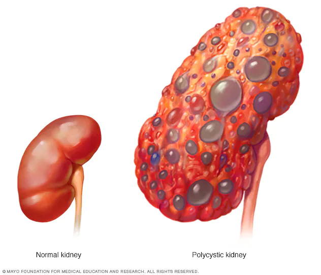 Understanding the Link Between Diabetes and Severe Kidney Problems