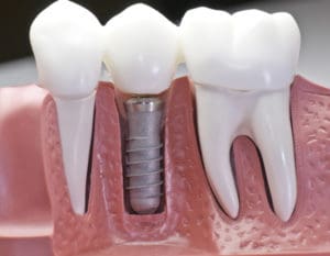 Exploring the Revolution of Dental Implants in the UK: A Comprehensive Guide